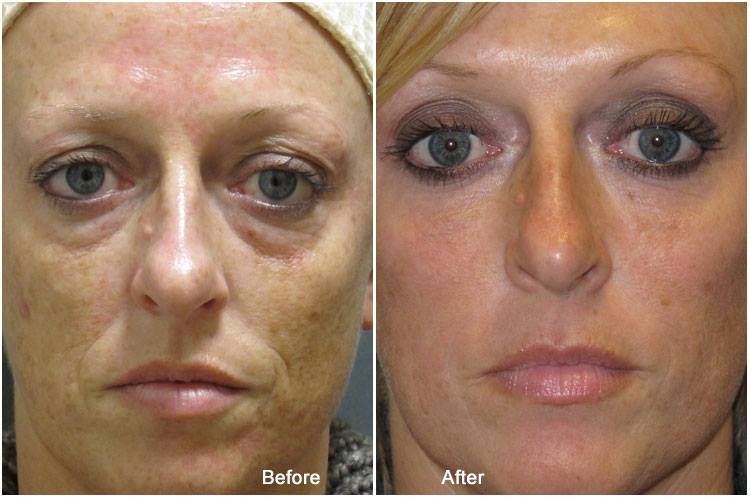 Before And After Photos - Revive Cosmetic and Skin Clinic Logan, Brisbane