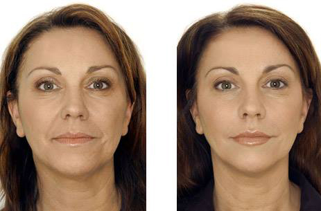 Before And After Photos - Revive Cosmetic and Skin Clinic Logan, Brisbane